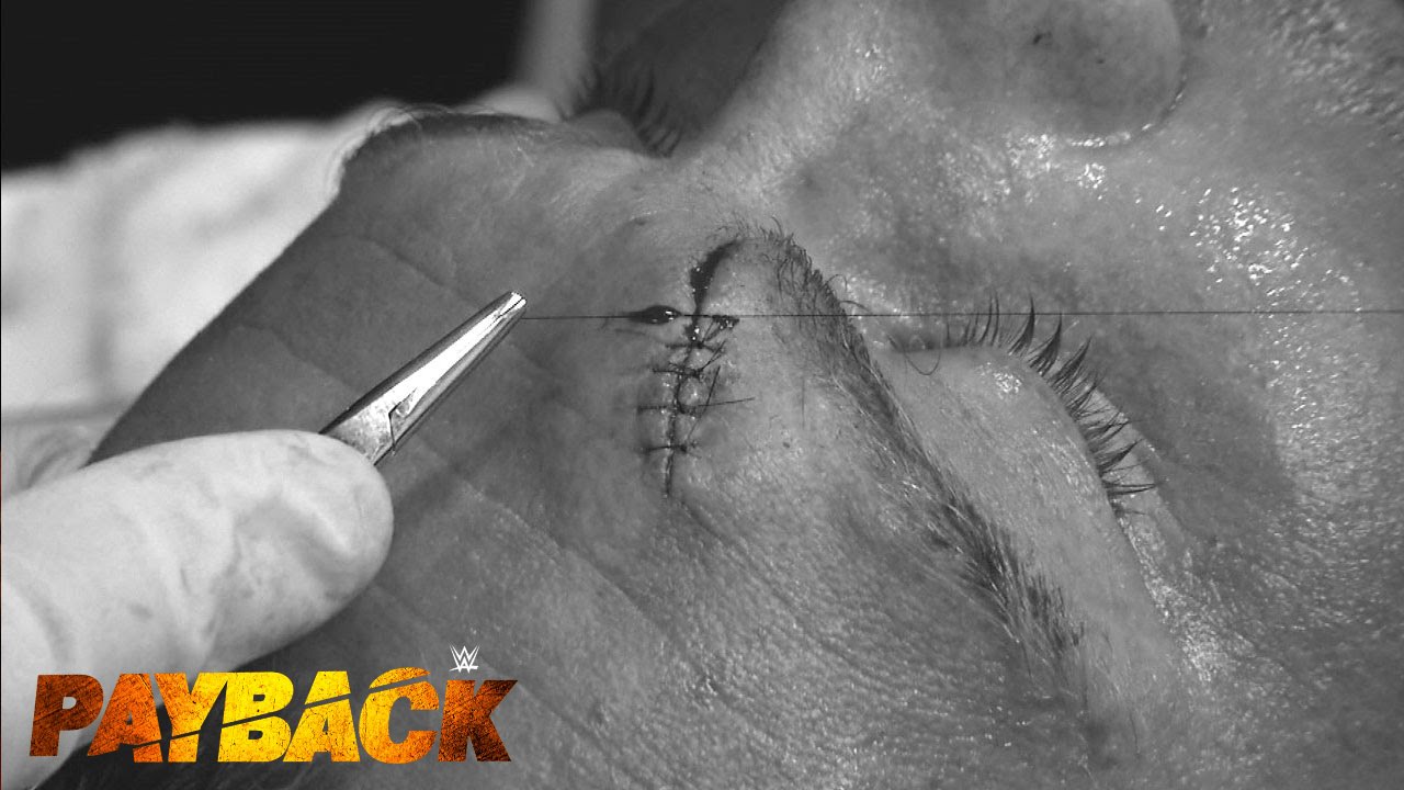 Watch Dolph Ziggler Bleeding: Intense Fight and Medical Attention